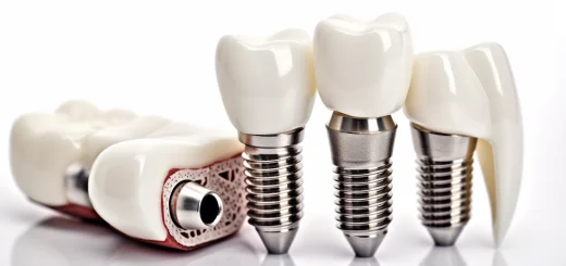 Implanty zębów w Krakowie